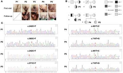 Four novel mutations identification in 17 beta-hydroxysteroid dehydrogenase-3 deficiency and our clinical experience: possible benefits of early treatment